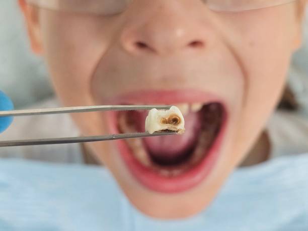 Best Emergency Treatment for Dental Infections or Abscesses in Graham, TX